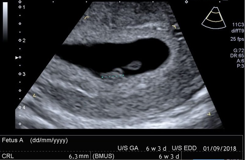 Ultrasonic pregnancy due date